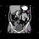 Appendicitis, appendicolith: CT - Computed tomography